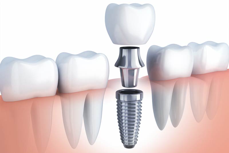 Dental Implants in Trumbull