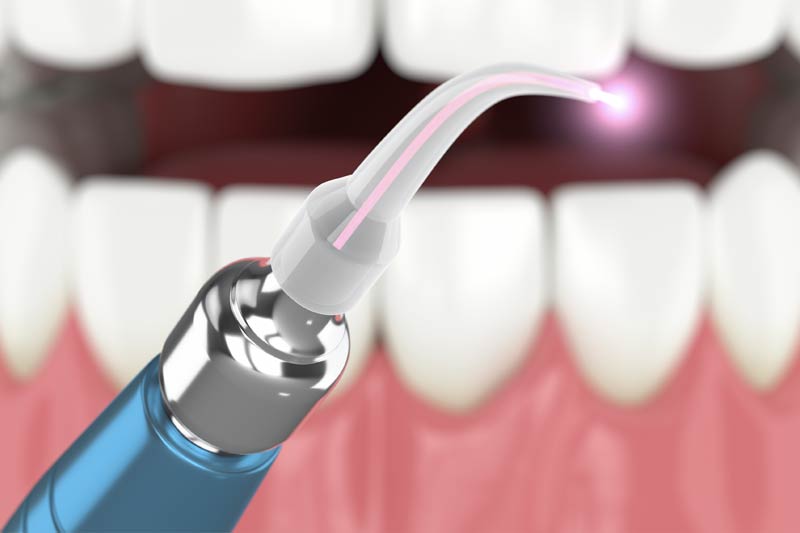 Laser Dentistry in Trumbull