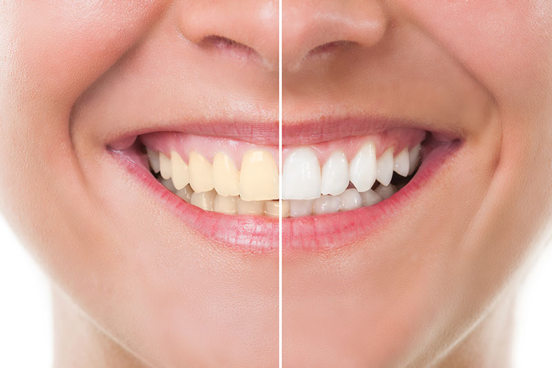 Teeth Whitening in 